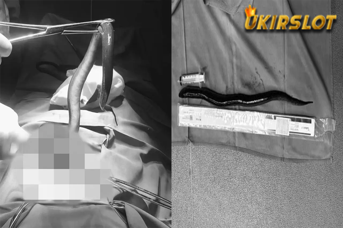 Aneh, Dokter Temukan Belut Hidup Sepanjang 30 Cm di Perut Seorang Pria